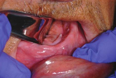 Note the folds of dense fibrous tissue in the anterior floor of mouth (epulis fissuratum). 2.