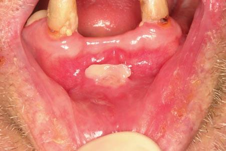 A focal lesion with a distinct wrinkled or folded appearance is often termed epulis fissuratum, and is most commonly encountered in the anterior buccal vestibule at the edge of a denture flange (Fig.