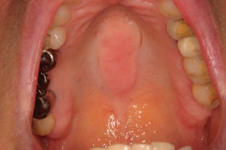 inflammatory-mediated reactive changes in the mucosa. As lesions may mimic other pathologic conditions, including proliferative verrucous leukoplakia and squamous cell carcinoma (see Chap.