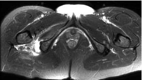 retraction T2 weighted MRI in a patient