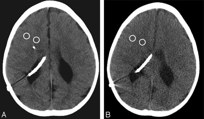 Fig 2. A,B, Attenuation characteristics of standard-dose and low-dose head CT studies in a 7-year-old girl with a shunt for hydrocephalus.