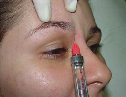 5 1 ml lidocaine right into the depression in the internal third of the eyebrows (supraorbital notch) with the needle pointed toward the forehead (Figs. 4.2 and 4.3). 4.6.2.2 Technique Inject 0.
