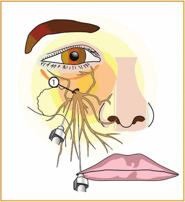 Anesthesia and Analgesia Chapter Fig. 4.5 Blocking of the infraorbital nerve (1) (de Maio 2004) 4.6.3.2 Technique The infraorbital foramen can usually be palpated.