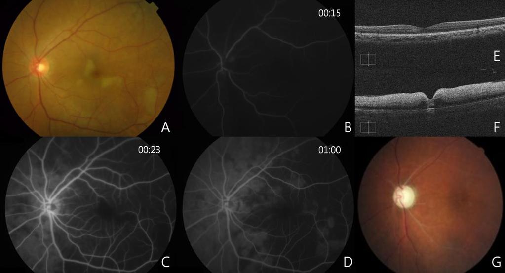 efigure 1. Generalized Posterior Ciliary Artery Occlusion With Relative Central Retinal Artery Sparing A 48-year-old woman (Patient 19) after facial autologous fat injection (specific site unknown).