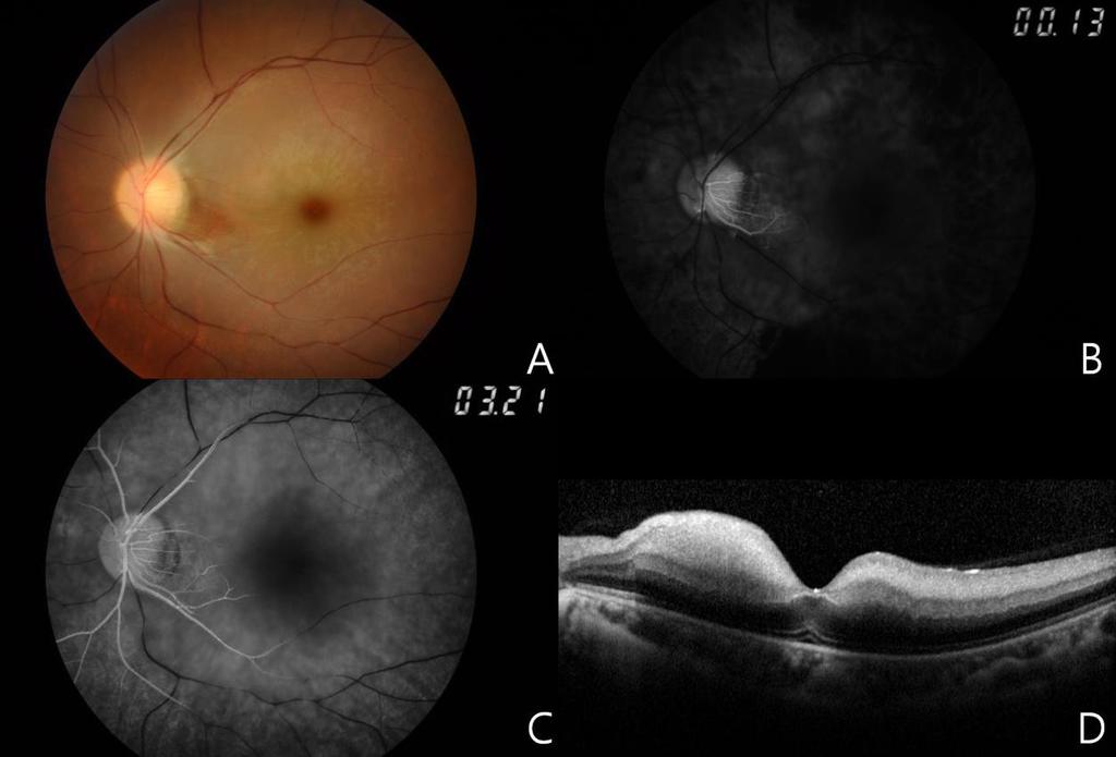 efigure 2. Central Retinal Artery Occlusion A 26-year-old woman (Patient 26) after autologous fat injection in the glabella and nasolabial fold.