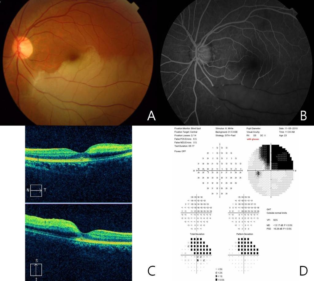efigure 4. Branch Retinal Artery Occlusion A 25-year-old woman (Patient 36) after facial filler injection (specific material unknown) in the nasal dorsum for rhinoplasty.