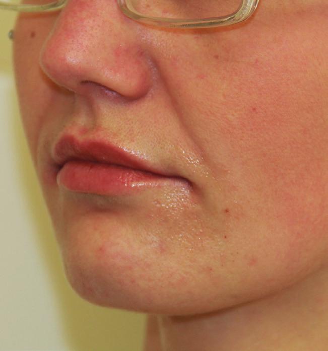 . Key points Cannulas have to be used in an indicationspecific way Indications such as the sunken-in lateral upper part of the cheeks or the jawline are very suited for the treatment using blunt