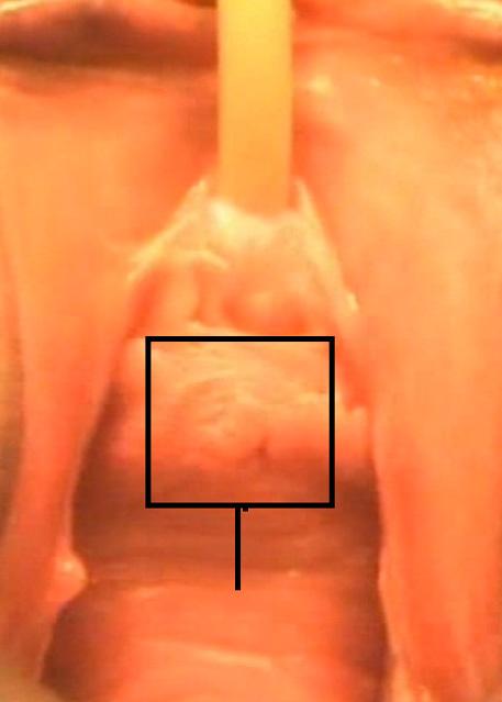 Figure 1. Schematic illustration of placard incision at the anterior vaginal wall.