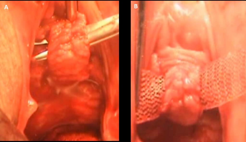 Figure 3. (A) Dissection below the in situ sling to pass the tape; (B) mid urethral tape passing below the in situ vaginal sling.