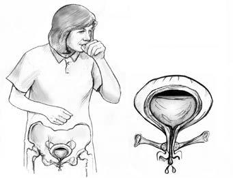 Center for Continence Care and Pelvic Medicine What is urinary incontinence? URINARY INCONTINENCE Urinary incontinence is the uncontrollable loss of urine.