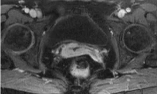 Sttus post hysterectomy for leiomyoms of the uterus.