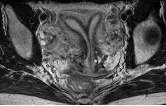 Vgin 281 Fig. 12.9 c. Uterus didelphys. T2-weighted imges in trnsverse nd coronl orienttion.