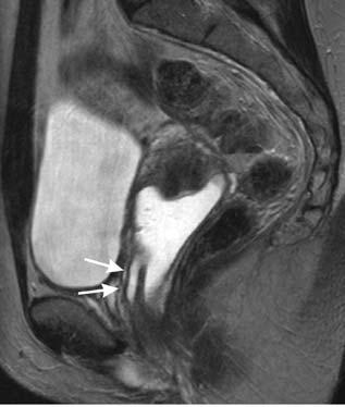 282 U. Zspel nd B. Hmm Fig. 12.10,. Brtholin s duct cyst. T2-weighted imge in sgittl orienttion.
