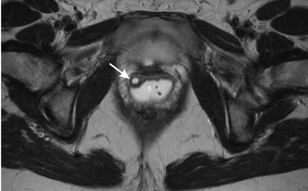 Depiction of Grtner s duct cyst (rrows) in the nterolterl portion of the right vgin 12.4.