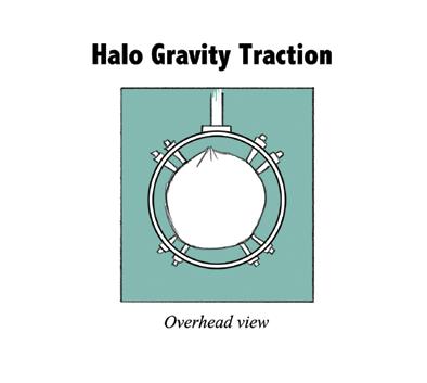Traction 14 15 What does halo gravity traction do? The goals of halo gravity traction are: 1. Gradually and safely make a curve smaller, 2. Make it easier for a patient to breathe effectively, 3.