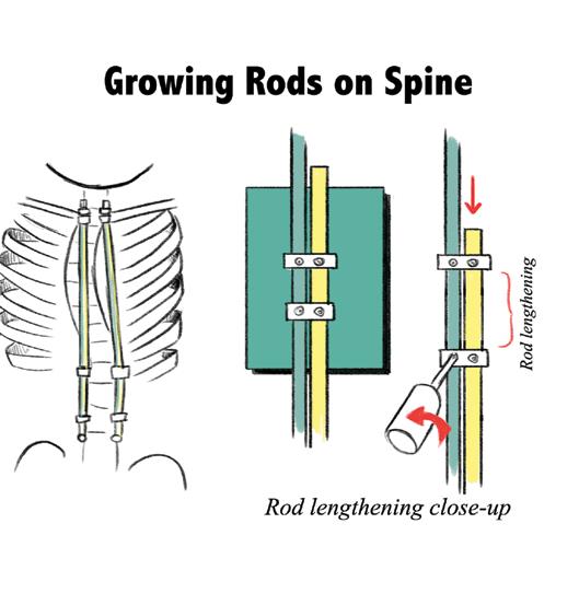 Growing Rods What are Growing Rods and how do they work?