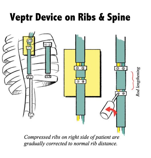 Prosthetic Titanium Rib) What is a VEPTR and how does it work?