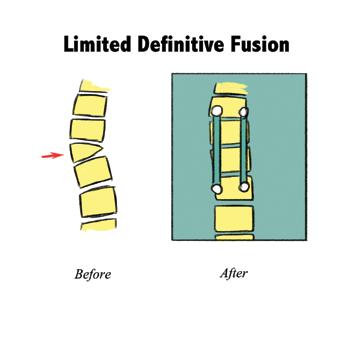 Fusion What is a definitive spinal fusion and how does it work in EOS? Definitive spinal fusion is when a curve in the spine has been corrected and will not grow any more.