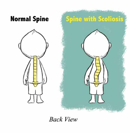 to Diagnosis What is Early-Onset Scoliosis?