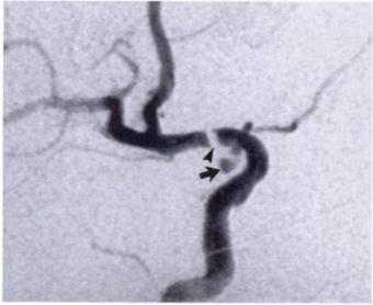 1 Posterior cerebral 3 0 1 3 0 1 Figure 1. Unexpected filling of residual aneurysm at the superior hypophyseal artery after initial clip placement.