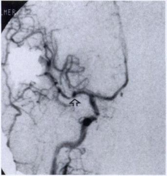 Adequate exposure of aneurysms of the superior cerebellan artery and of the bifurcation of the internal carotid artery may also be difficult.