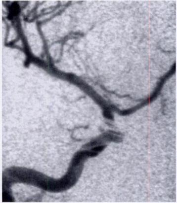 (b) On the anteroposterior intraoperative angiogram, no definite residual aneurysm filling is depicted, and the study was considered to he normal.