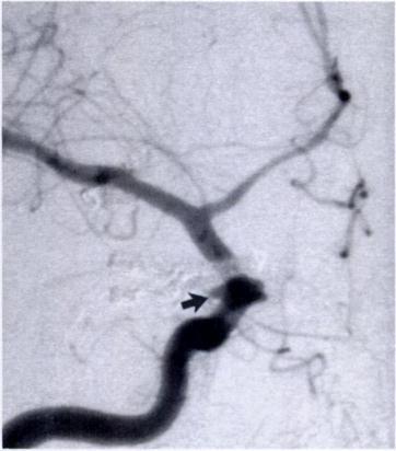 (d) Findings on the lateral intraoperative angiogram are unremarkable and are similar those on (e) the postoperative lateral angiogram.