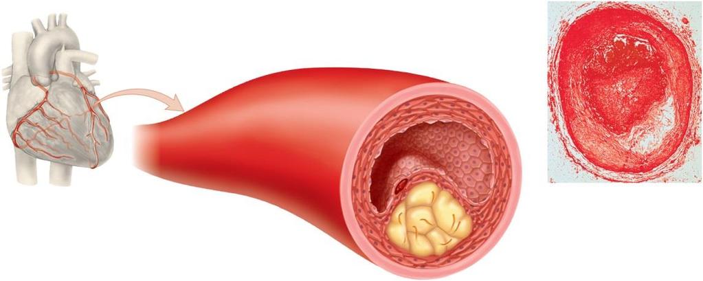 Development of cardiovascular disease 3- Atherosclerosis: development of plaque - Plaque formation increases likelihood of clots forming - 95% of all heart attacks are caused by these clots - First