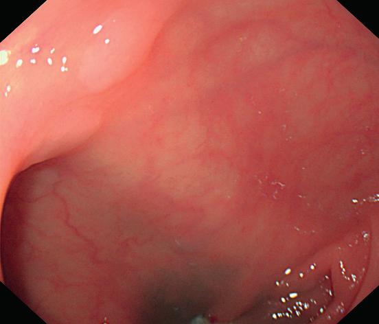 NBI for detection of polyps in patients with SPS A A A AA A B B B BB B explanation for the
