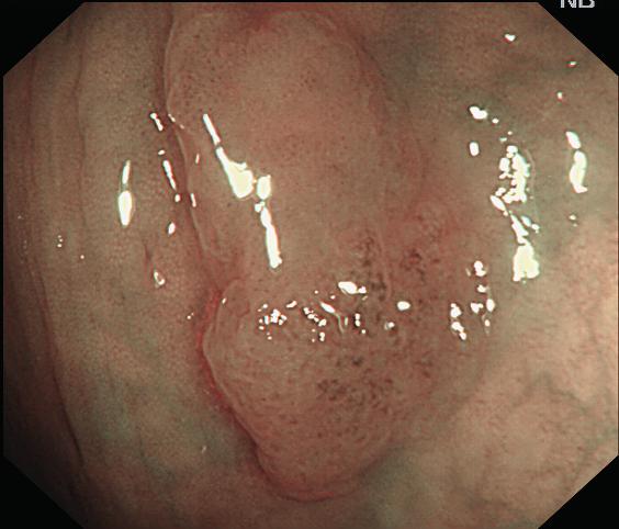NBI significantly reduced the polyp miss-rate of hyperplastic polyps.