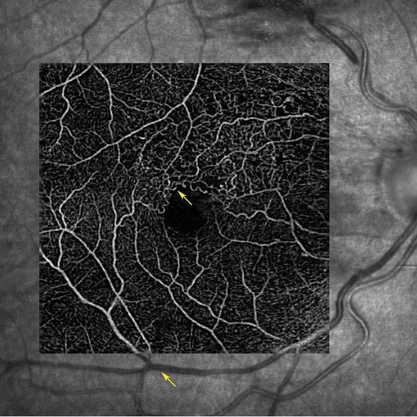 1 Fundus Photography: Intraretinal hemorrhage associated with edema, surrounded by circinate lipid deposition just superior to foveal