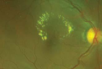 center of fovea, draining into retinal venule.