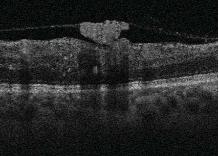 Proliferative diabetic retinopathy Case Report 5918 PROLIFERATIVE DIABETIC RETINOPATHY 1 8-year-old