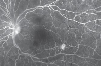 After laser treatment, OCT reveals fibrotic remnant of NVE in pre-retinal location [image 5], and