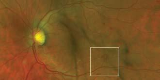 1 Fundus Photography: Mild central vitreous hemorrhage and moderately ischemic retina in all four