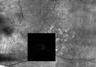 Fluorescein Angiography: Proliferative diabetic retinopathy with subtle optic disc