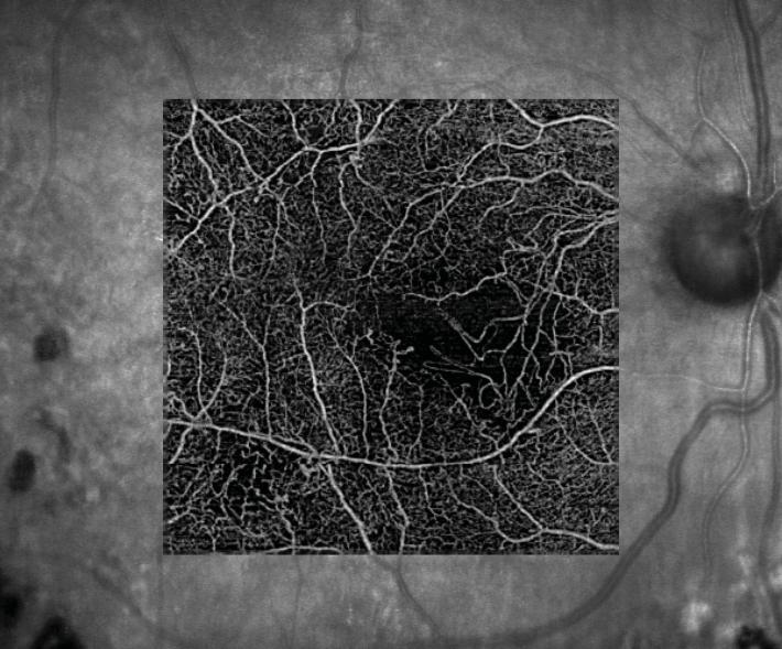 Proliferative Diabetic Retinopathy (PDR) Case Report 969 PROLIFERATIVE DIABETIC RETINOPATHY 1 1-year-old diabetic female presents for follow-up of