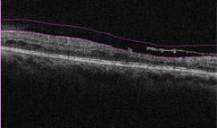 5 AngioPlex OCT Angiography (OCT-A) reveals persistent flow in neovascularization of optic disc (NVD) and neovascularization elsewhere (NVE)