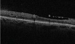 Patient referred to retinologist for evaluation of chronic, possibly indolent, neovascularization to see if additional panretinal laser OD is