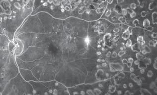 weeks. Additional retinal photocoagulation may be required in the future. 1 Fundus Photography: Persistent central diabetic macular edema OS.
