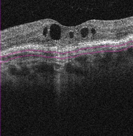 Neovascular age-related macular degeneration Case Report 7 NEOVASCULAR (WET) AMD 1 69-year-old male patient, who has been treated with anti-vegf injections OS for wet age-related macular degeneration