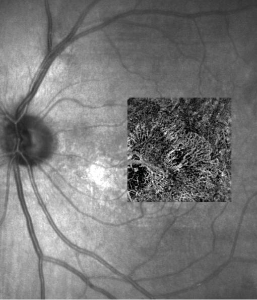 Most recent intravitreal anti-vegf OS was 7 weeks prior, and first and only photodynamic therapy OS 8 months prior.