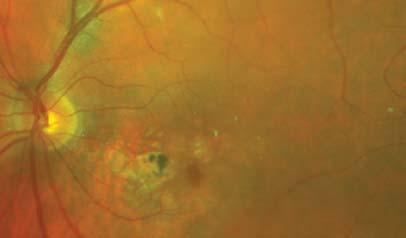 The frequency of intravitreal anti-vegf inejctions was increased to every five weeks to address the persistent intraretinal fluid.