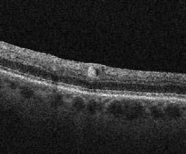Branch retinal artery occlusion Case Report 6605 BRANCH RETINAL ARTERY OCCLUSION 1 81-year-old male patient with history of systemic hypertension, coronary artery disease, and JAK mutation positive