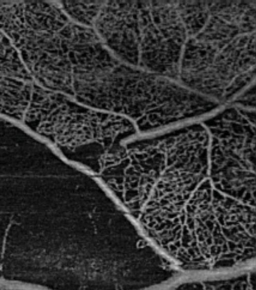 Repeat fundus examination directed by OCT-A revealed the presence of an 100 X 70 -micron white embolus in the inferotemporal branch retinal arteriole, mm inferior to the foveal center OD.