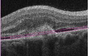 Fluorescein Angiography: Leakage from extrafoveal choroidal neovascular membrane surrounded by small rim of
