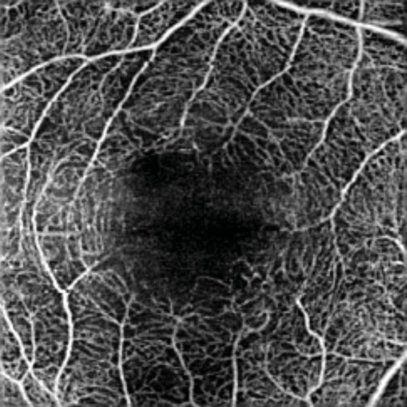 1 Fundus Photography: Bilateral, subfoveal, slightly elevated yellow lesion at the level of the RPE, more severe in OD.