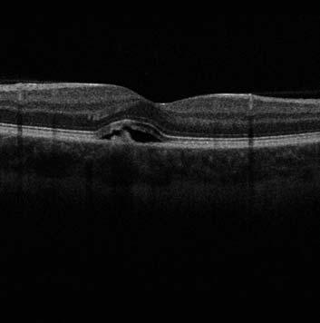Central serous chorioretinopathy Case Report 599 CENTRAL SEROUS CHORIORETINOPATHY 1 6-year-old female patient with 1-day