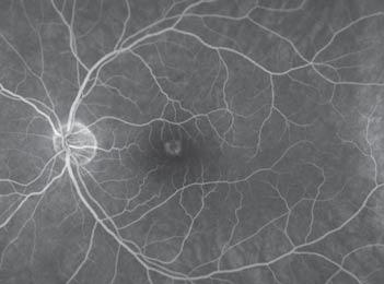 OCT Angiography: No abnormal vessels seen at the level of choroid or RPE.