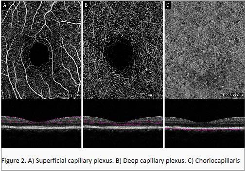 Beth A. Steele, OD, FAAO OCT A: Introduction Isolates microvascular circulation from OCT image data Axial resolution = 5 microns (i.e. fine capillaries visible) Visualization of blood flow in the